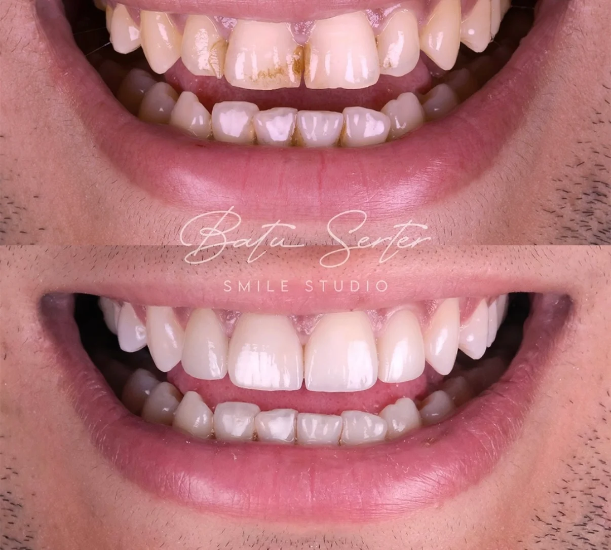 Önce / Sonra — Batu Serter Smile Studio