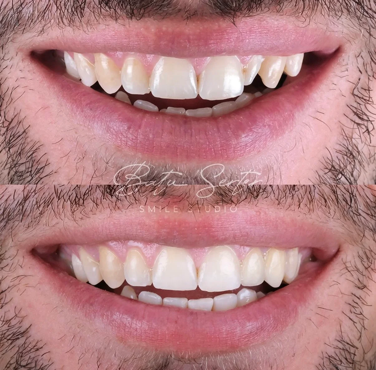 Önce / Sonra — Batu Serter Smile Studio