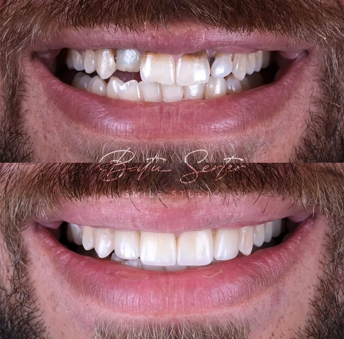 Önce / Sonra — Batu Serter Smile Studio