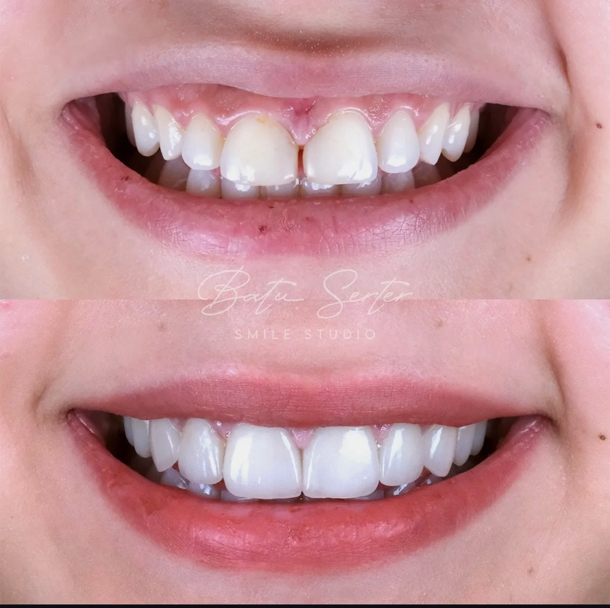 Önce / Sonra — Batu Serter Smile Studio