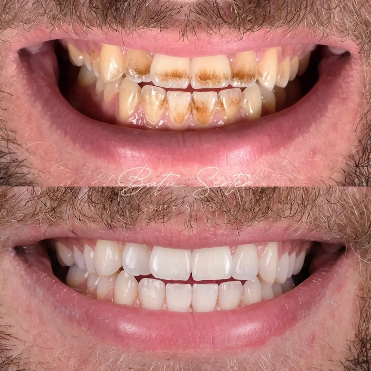 Önce / Sonra — Batu Serter Smile Studio