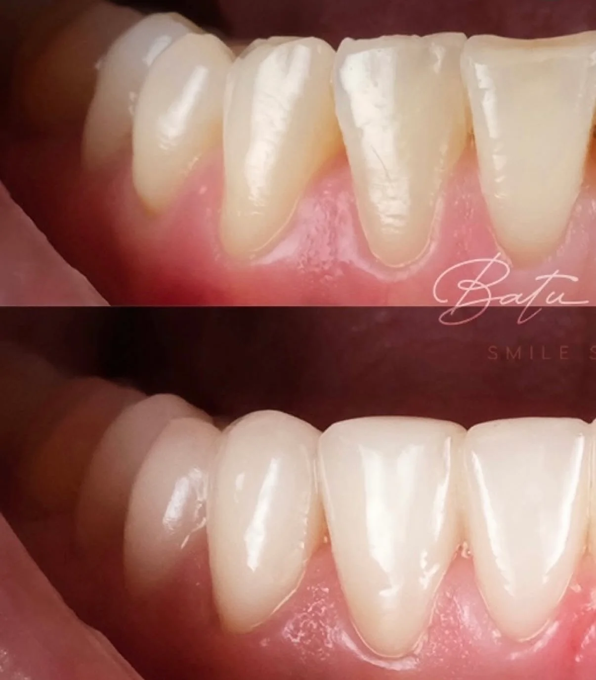 Önce / Sonra — Batu Serter Smile Studio