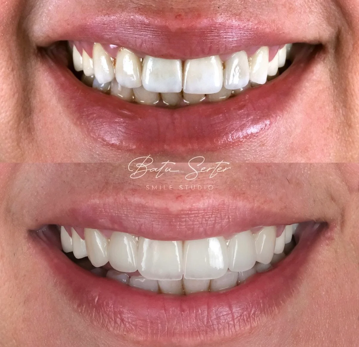 Önce / Sonra — Batu Serter Smile Studio