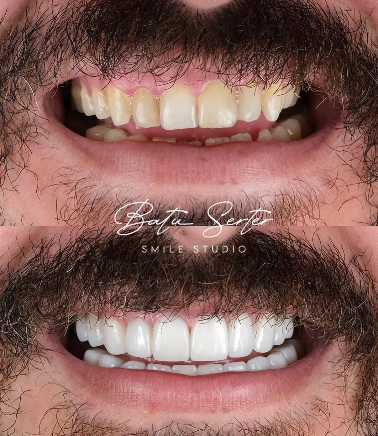 Önce / Sonra — Batu Serter Smile Studio