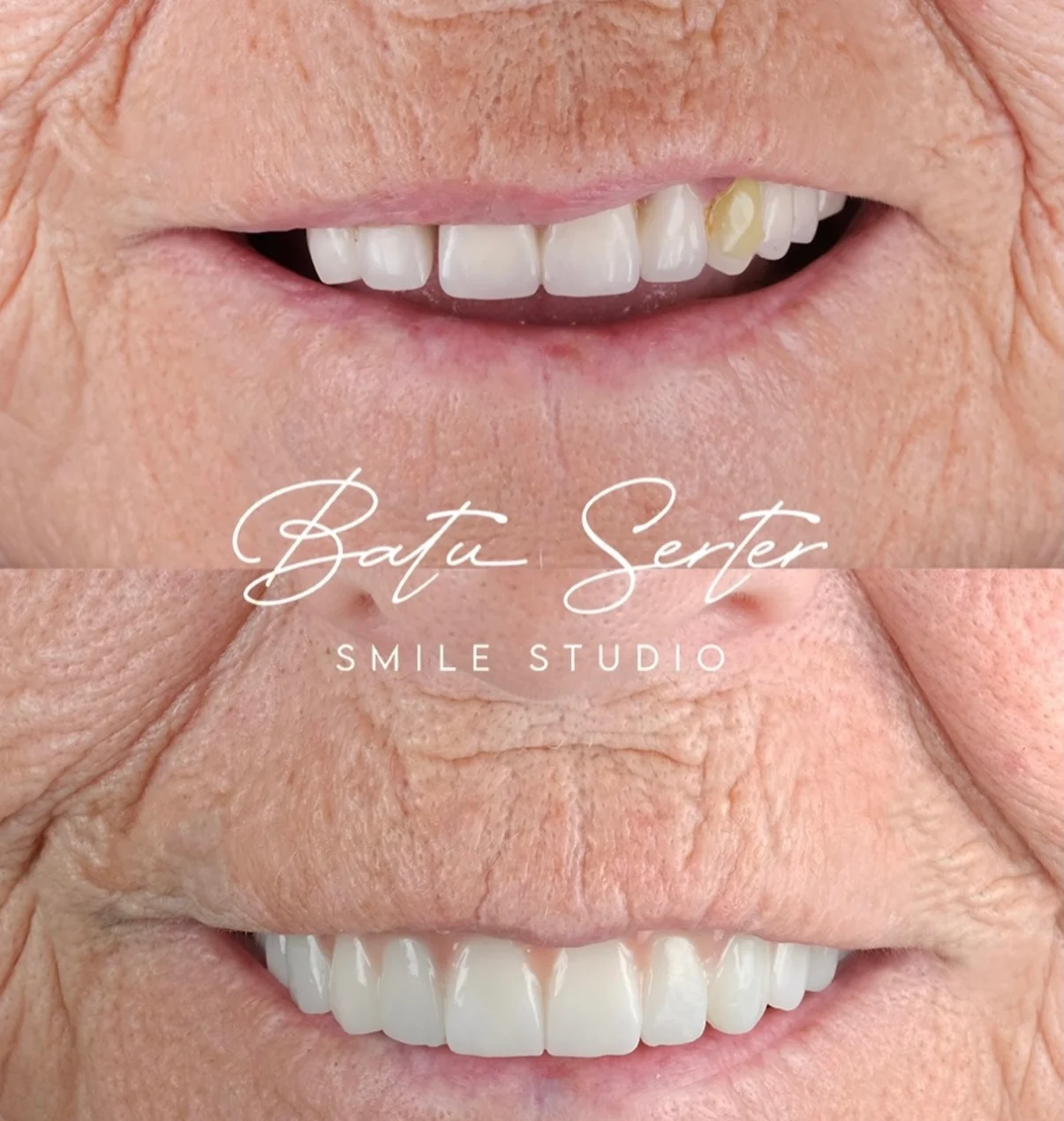 Önce / Sonra — Batu Serter Smile Studio