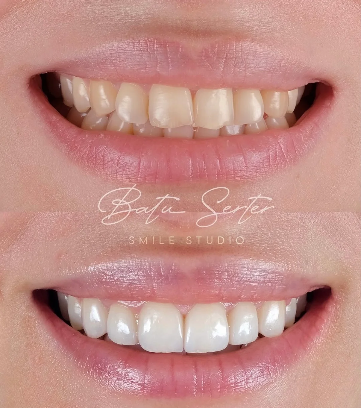 Önce / Sonra — Batu Serter Smile Studio